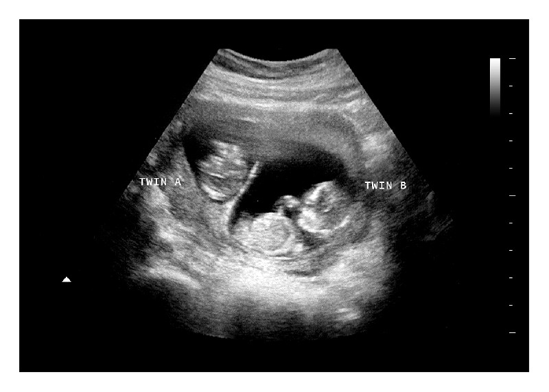 12 Weeks Twins Fake Ultrasound