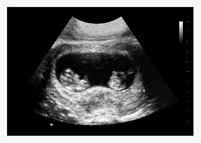 8 Weeks Twins Fake Ultrasound