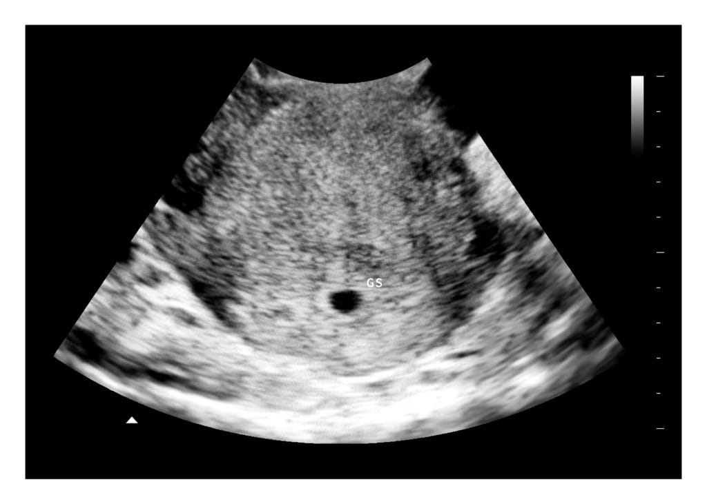 4 Weeks Fake Ultrasound Image