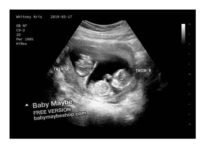 Fake Ultrasounds Explained: The 
