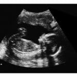 12-Weeks 2d Ultrasound - Digital PDF