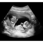 12-Weeks Twins 2d Ultrasound - Digital PDF