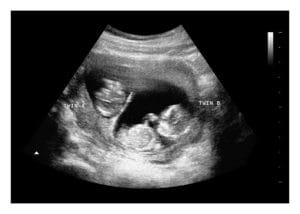 12 Weeks Twins Fake Ultrasound Image