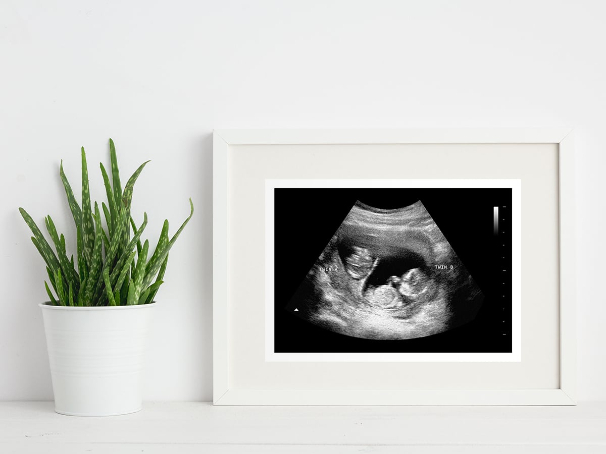 12 week twins ultrasound in a frame