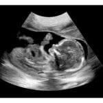 16-Weeks 2d Ultrasound - Digital PDF