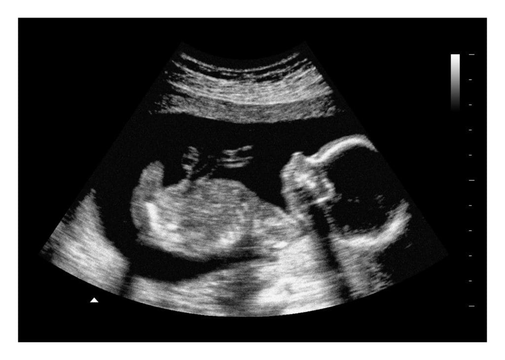 20 Weeks Fake Ultrasound Image