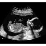 20-Weeks 2d Ultrasound - Digital PDF