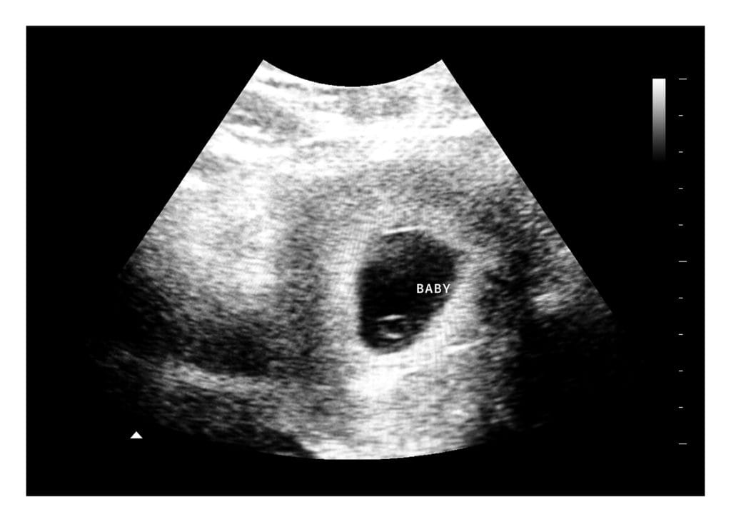 5 Weeks Fake Ultrasound Image