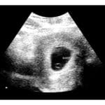 5-Weeks 2d Ultrasound - Digital PDF