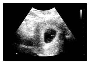 5 Weeks Fake Ultrasound Image