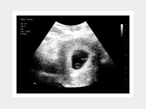 5 Weeks Fake Ultrasound Image