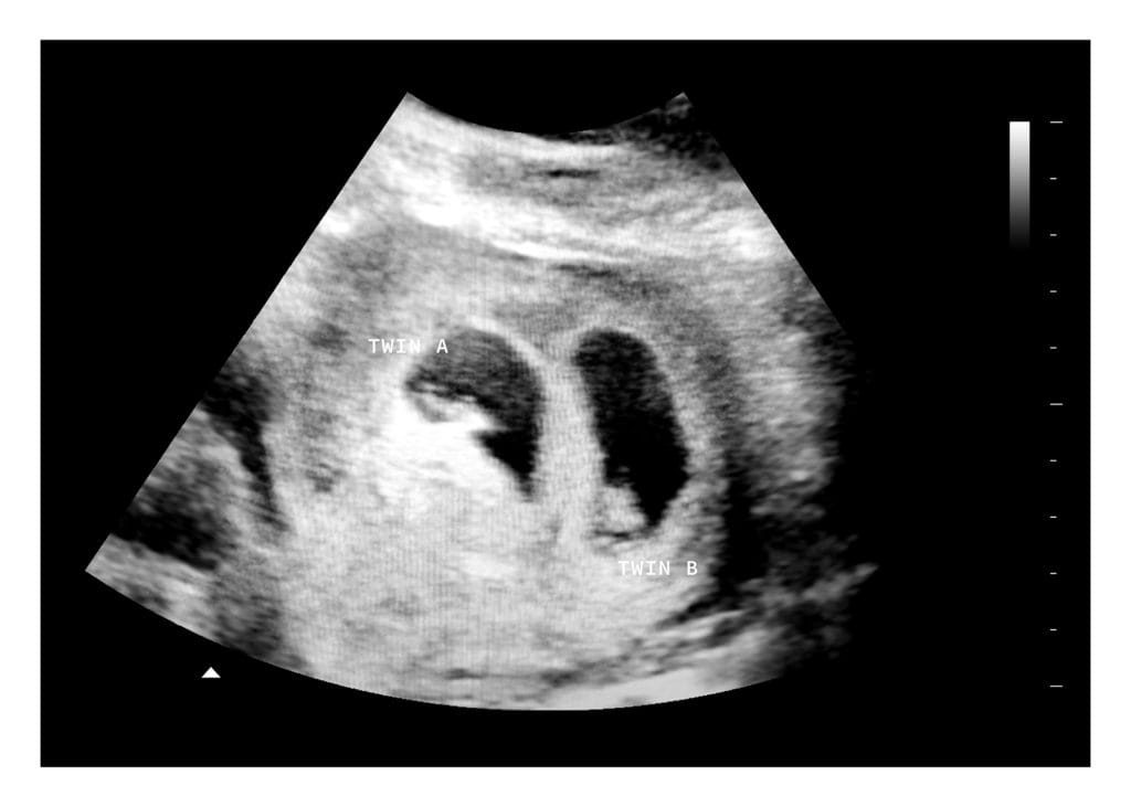 5 Weeks Twins Fake Ultrasound Image