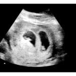 5-Weeks Twins 2d Ultrasound - Digital PDF