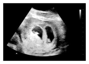 5 Weeks Twins Fake Ultrasound Image