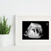 5 week twins ultrasound in a frame