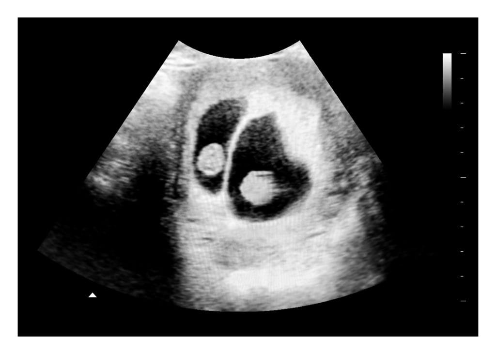 6 to 7 Weeks Twins Fake Ultrasound Image