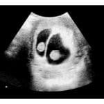 6-to-7-Week Twins 2d Ultrasound - REAL Thermal Strip + PDF