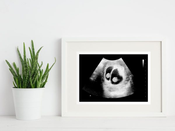 6-7 week twins ultrasound in a frame