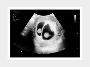 6 to 7 Weeks Twins Fake Ultrasound Image