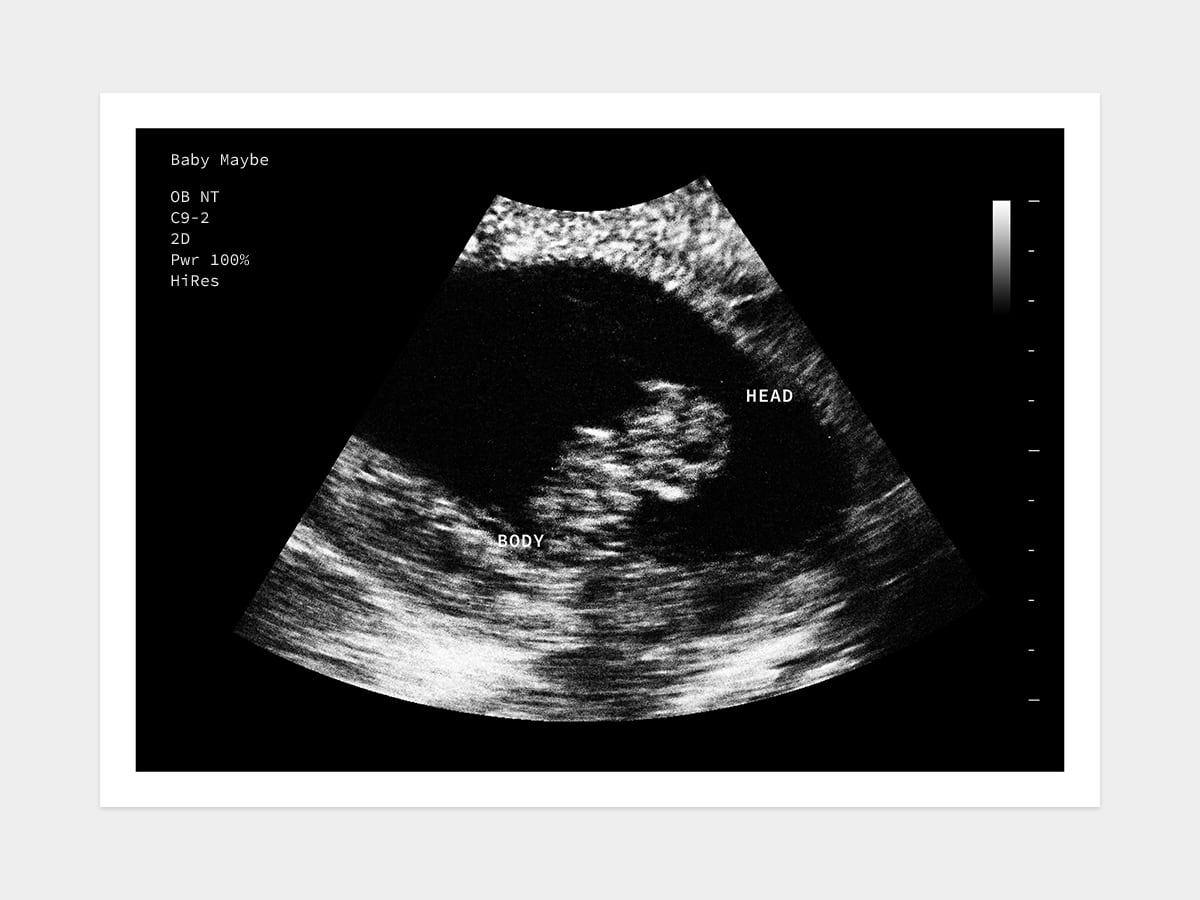 Week normal ultrasound 8 Fetal Heartbeat: