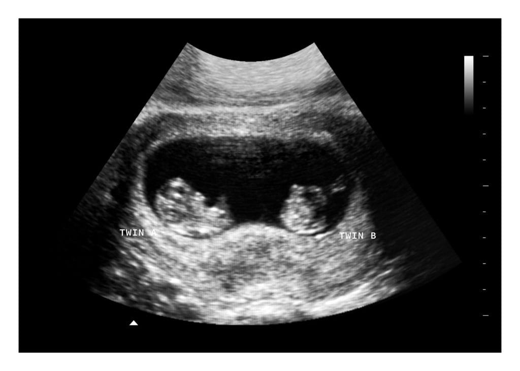 8 Weeks Twins Fake Ultrasound Image