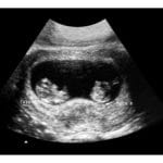 8-Weeks Twins 2d Ultrasound - Digital PDF