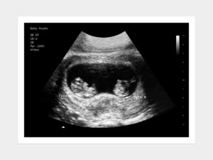 8 Weeks Twins Fake Ultrasound Image