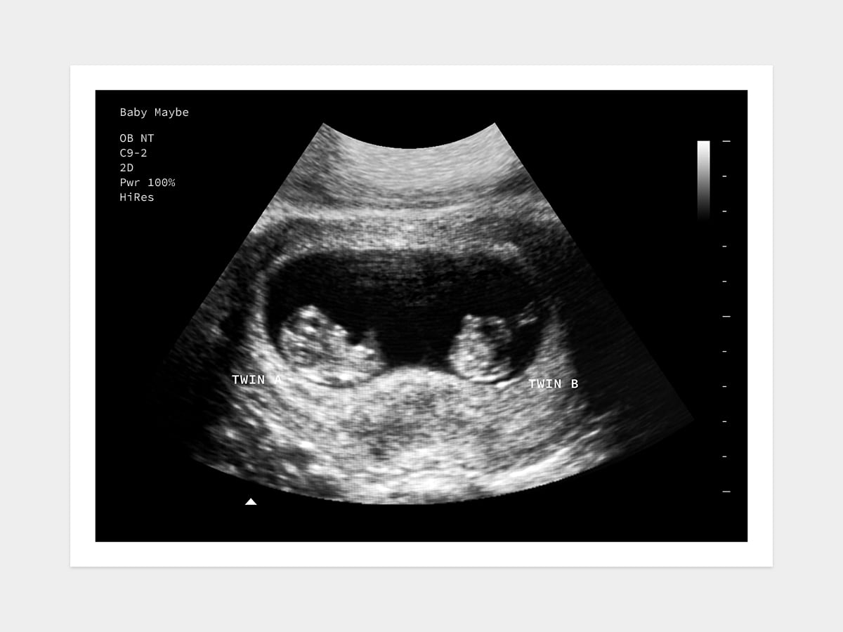 8 Weeks Twins Fake Ultrasound w/ Instant Download!