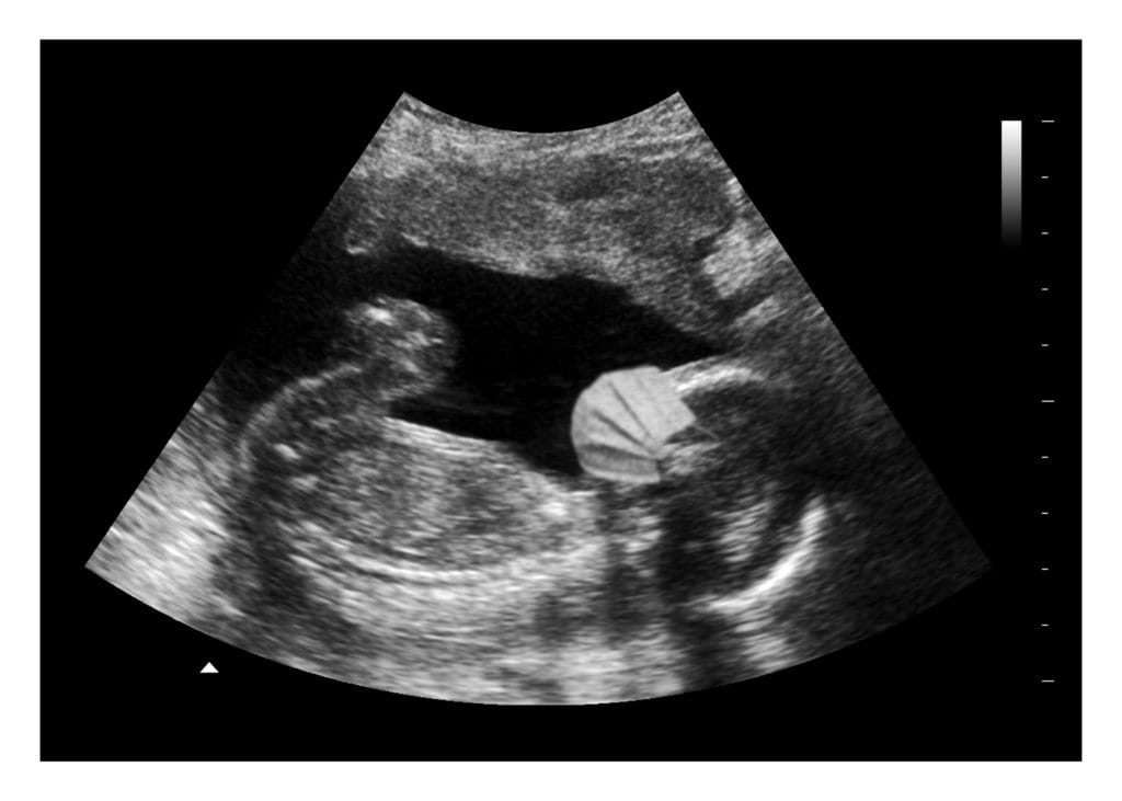 Covid Baby Fake Ultrasound Image Highres