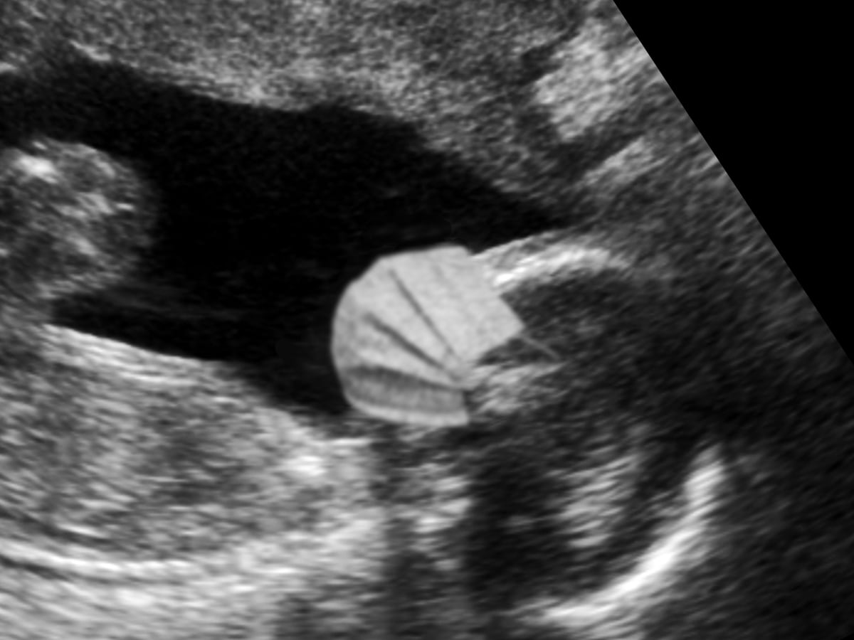 Covid Baby Fake Ultrasound Image Zoomed In