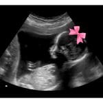 Gender Reveal 2d Ultrasound - Digital PDF