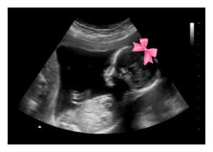 Pink Bow Gender Reveal Fake Ultrasound