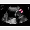 Pink Bow Gender Reveal Fake Ultrasound image