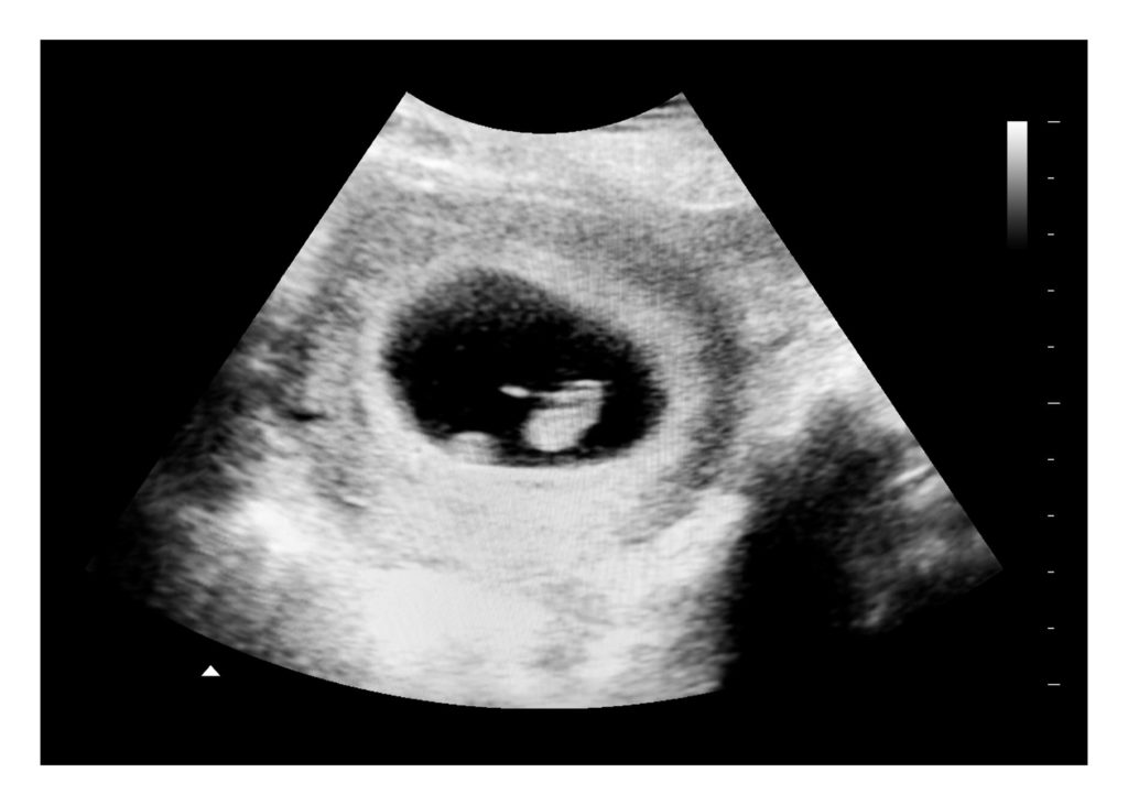 6 weeks ultrasound image