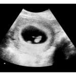 6-Weeks 2d Ultrasound - Digital PDF