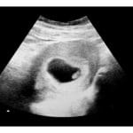 6 weeks ultrasound image