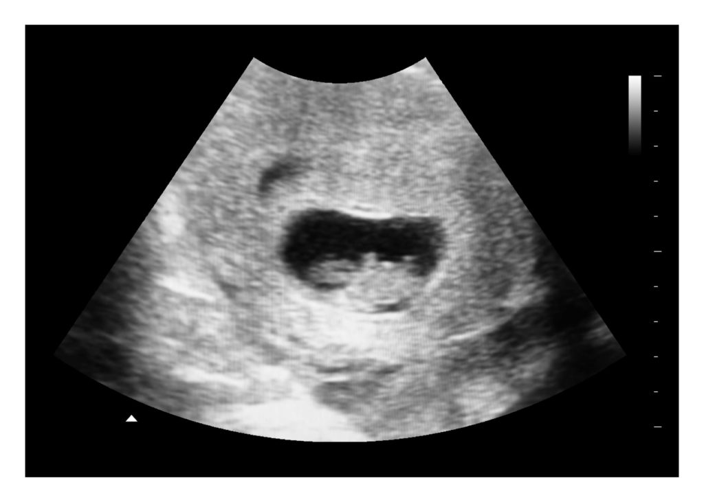 7 weeks ultrasound image