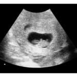 7-Weeks 2d Ultrasound - REAL Thermal Print + PDF