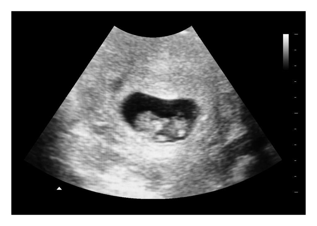 7 weeks ultrasound image