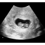 7 weeks ultrasound image