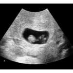7 weeks ultrasound image