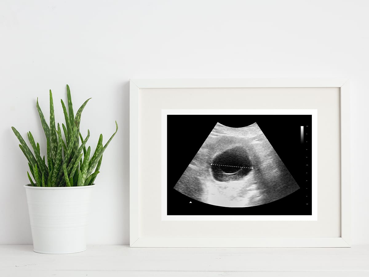 Blighted ovum ultrasound in a frame