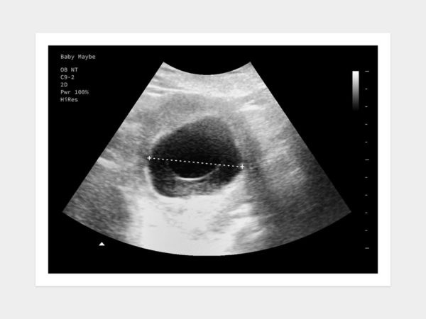 Blighted ovum ultrasound image