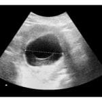 Blighted ovum ultrasound image