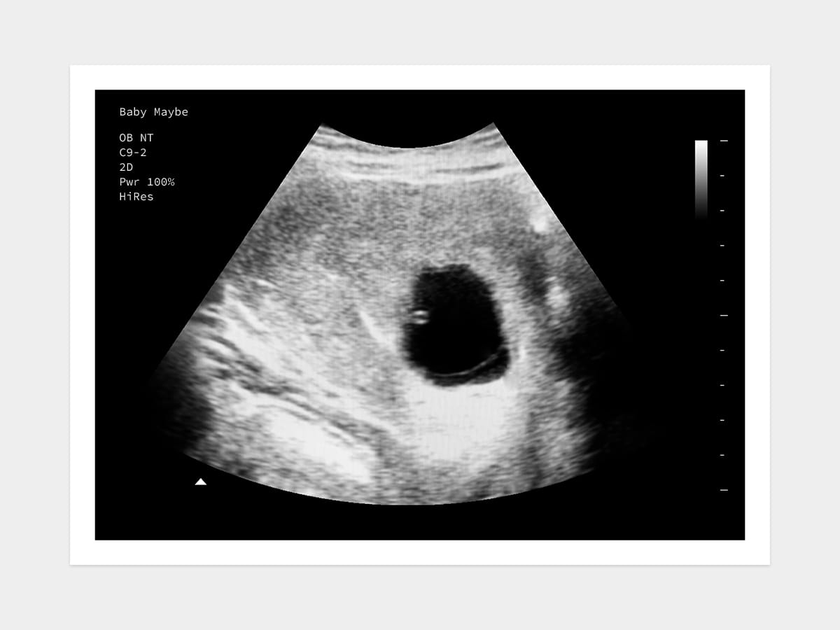 Blighted ovum ultrasound image
