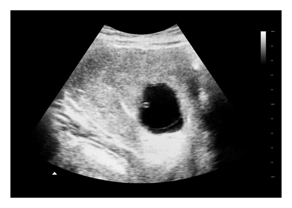 Blighted ovum ultrasound image