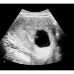 Blighted ovum ultrasound image