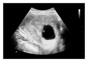 Blighted ovum ultrasound image