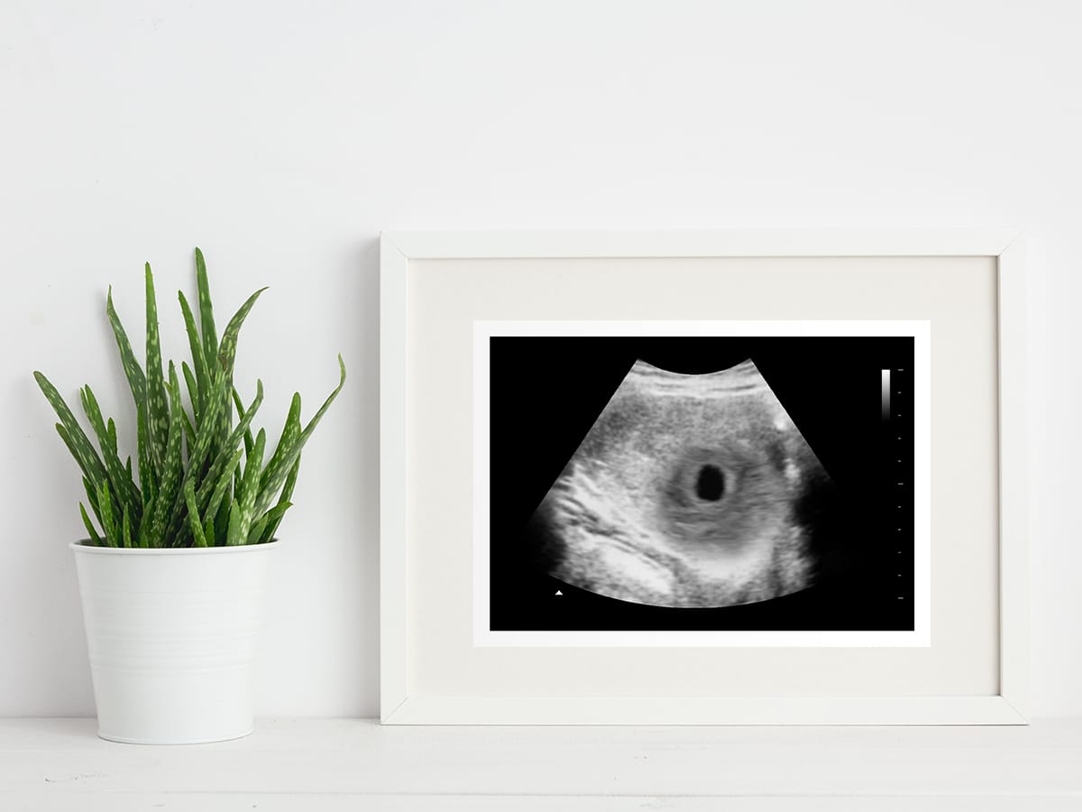 Miscarriage ultrasound in a frame