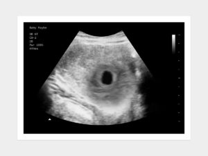 Miscarriage ultrasound image
